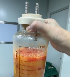 大丰水动力吸脂手术要做多久？